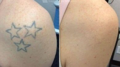 Tattoo Removal