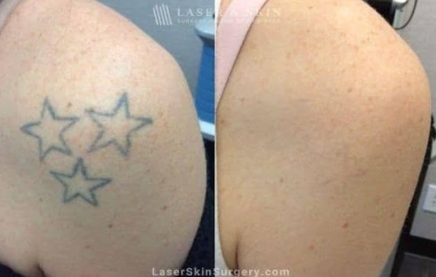 Tattoo Removal